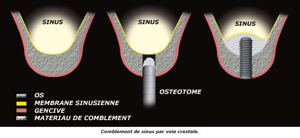 comblement-cretal