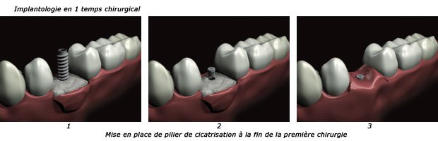 implantologie-1t-c