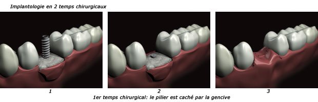 implantologie-2t1-c