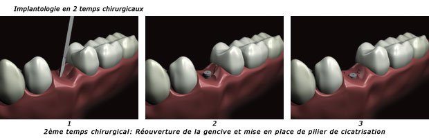 implantologie-2t2-c2