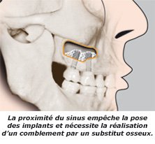 sinus-profil2