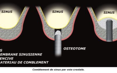 Différents matériaux de comblement osseux