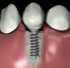 dental_implant_france