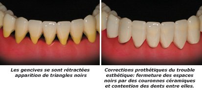 teeth move