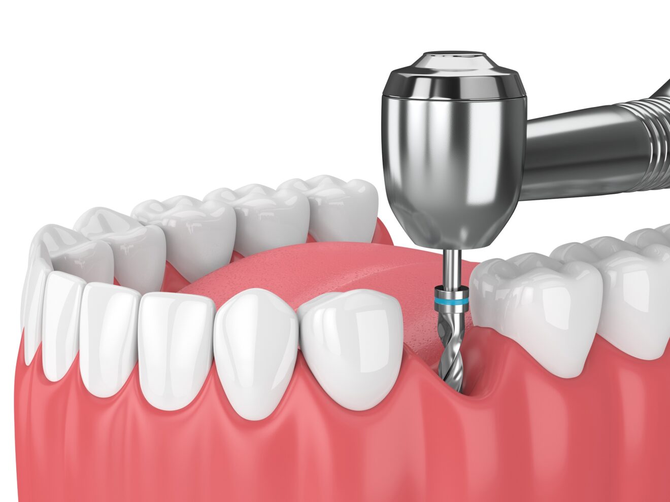 machoire avec implant dentaire