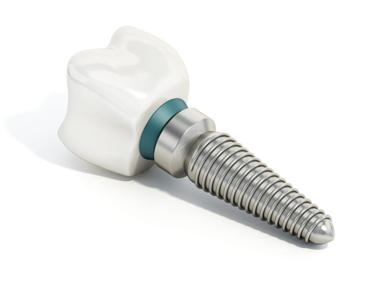 implant dentaire titanium