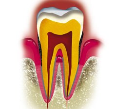 periodontitis