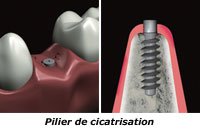 pilier-cicatrisation_implant_dentaire nice