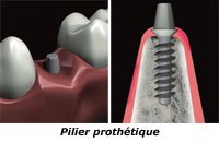 pilier-prothetique-implant_dentaire nice