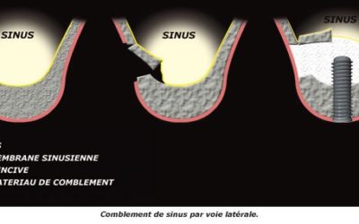 Le comblement de sinus voie latérale