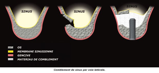 sinus-comblement_dentiste_nice