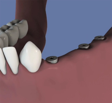 Bridge-transvisse-de-4-dents-sur-3-implants