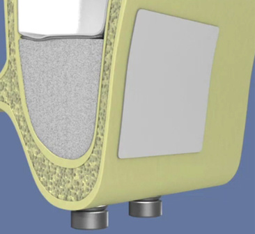 Comblement-de-sinus-par-voie-laterale-et-implantation-simultanee