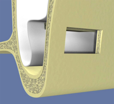 comblement-de-sinus-par-abord-lateral-et-implantation-differee