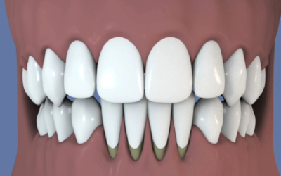 Greffe Gingivale