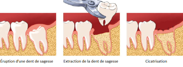 Extraction dents de sagesse - Chirurgien-Dentiste Dr Laurine BIRAULT