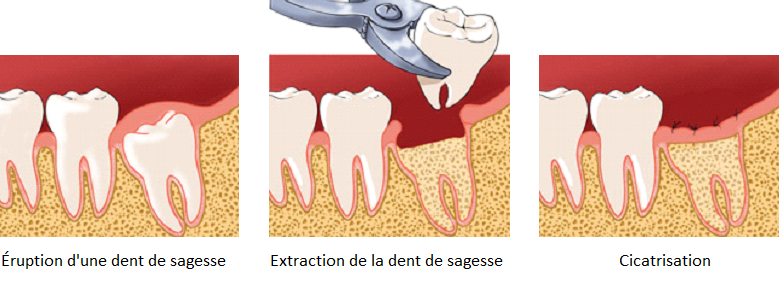 Extraction dents de sagesse - Chirurgien-Dentiste Dr Laurine BIRAULT