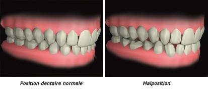 malposition dentaire image double