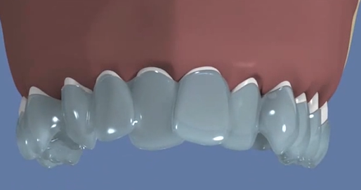 Invisalign