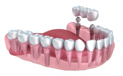 Qu’est-ce qu’un implant dentaire ?