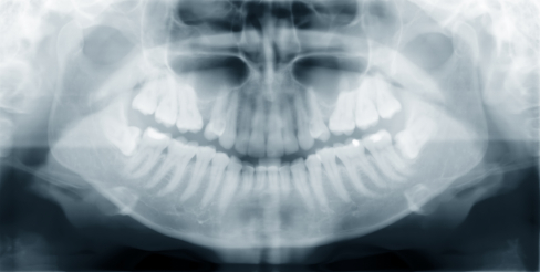 malocclusion dentaire