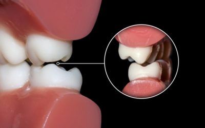 Malocclusions dentaires et traitements orthodontiques