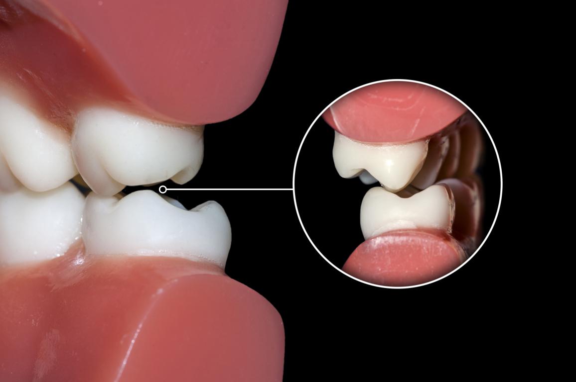 malocclusion dentaire