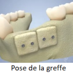 Pose de la greffe