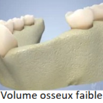 Volume osseux faible