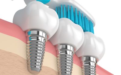 Comment entretenir ses couronnes sur implants ?