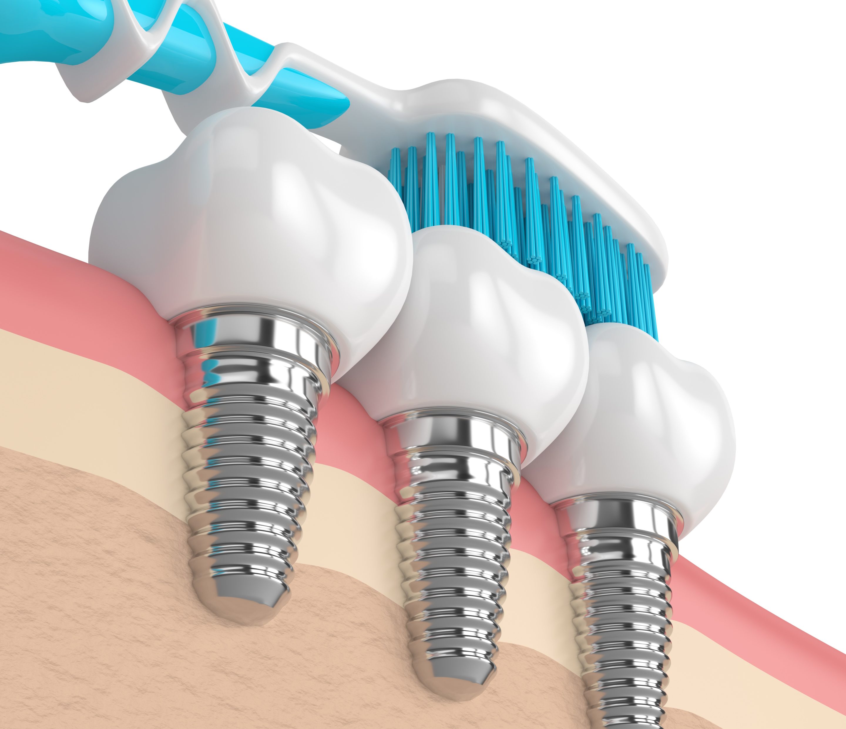 Comment bien entretenir ses aligneurs ? - Dentiste Nice - Implants  dentaires Nice - Cabinet dentaire du Dr DISS