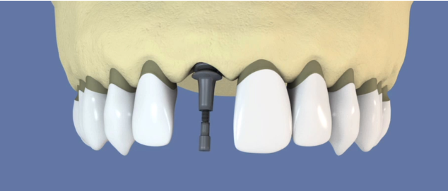 ortho et implant dentaire