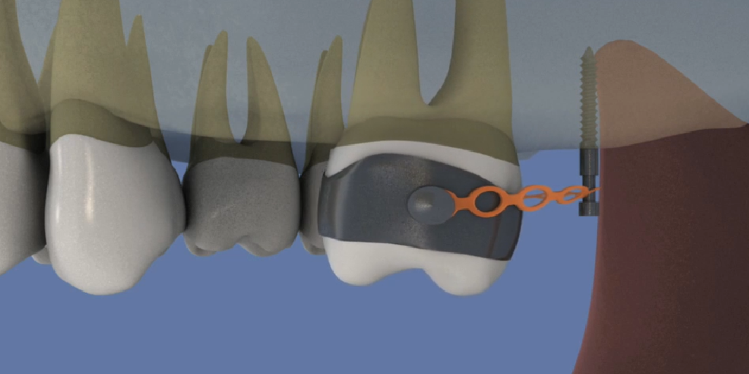 Bridge-transvisse-de-4-dents-sur-3-implants