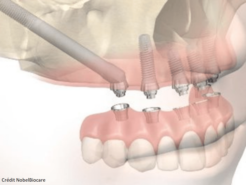 implant sans greffe osseuse _ zygomatiques