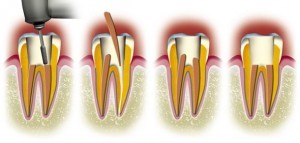 root canal tooth