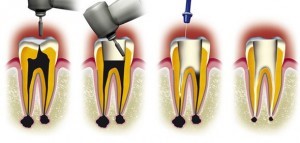 root canal treatment