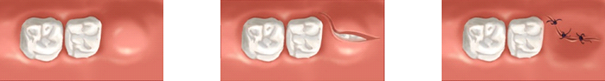 Wisdom Tooth Extraction