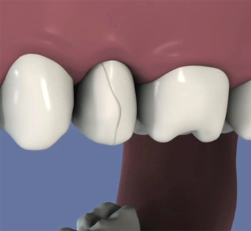 Bridge-transvisse-de-4-dents-sur-3-implants