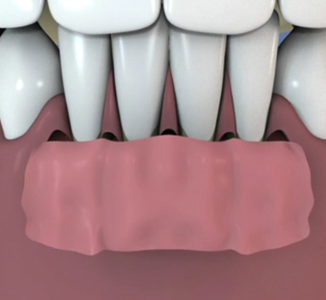 Bridge-transvisse-de-4-dents-sur-3-implants