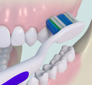 Bridge-transvisse-de-4-dents-sur-3-implants
