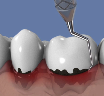 Maxillaire-all-on-six-et-comblement-de-sinus