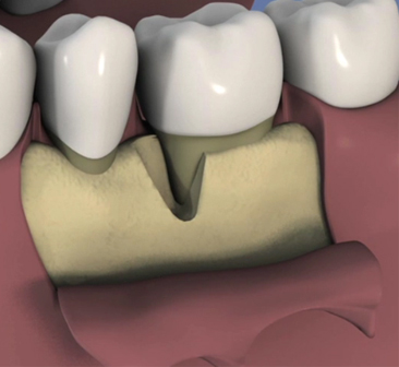 Extraction-implantation-et-mise-en-esthetique-immediate