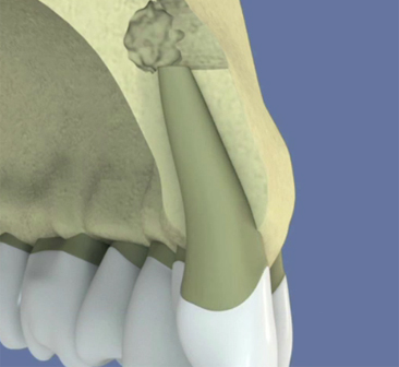 Implant-et-regeneration-osseuse