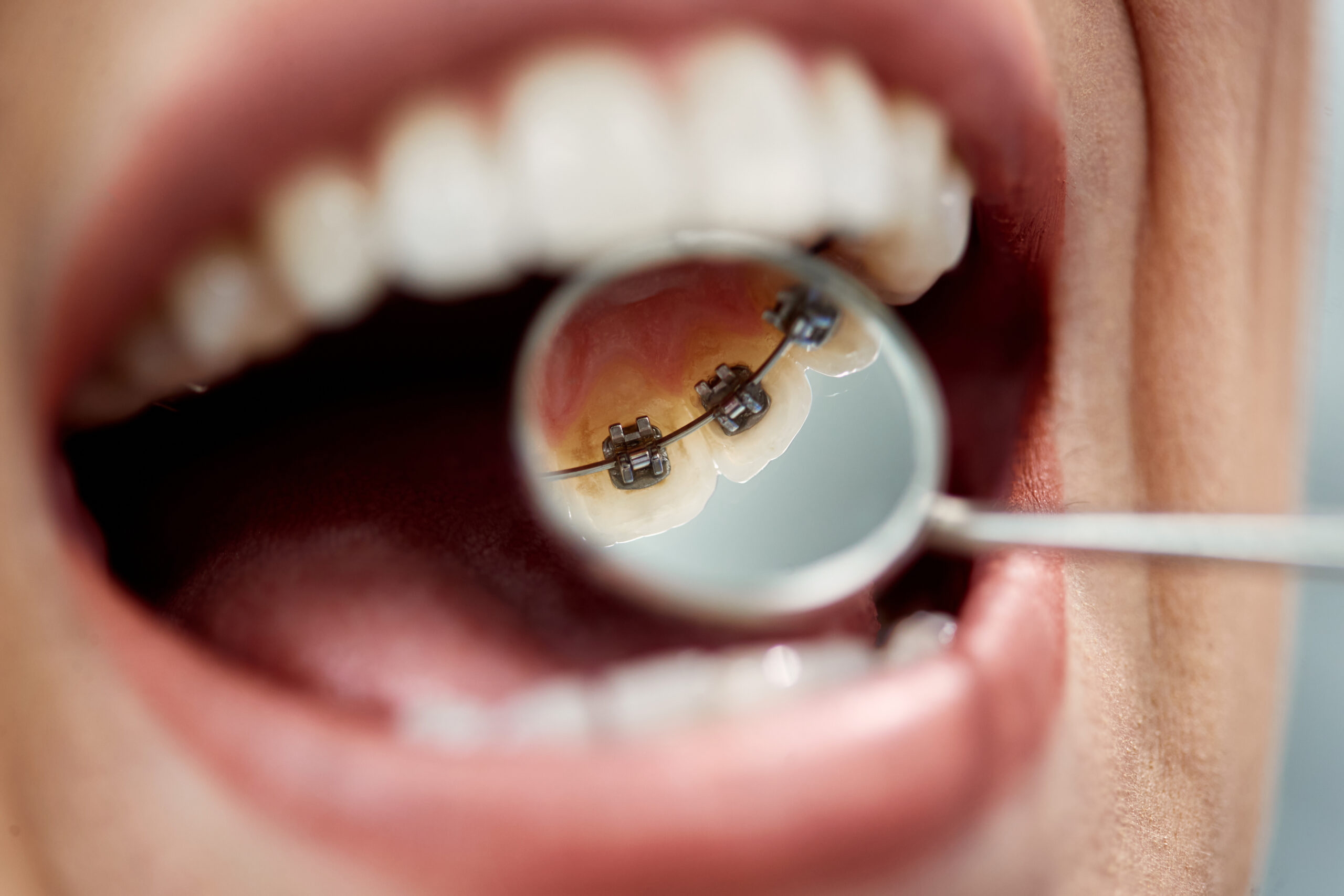 Orthodontie linguale