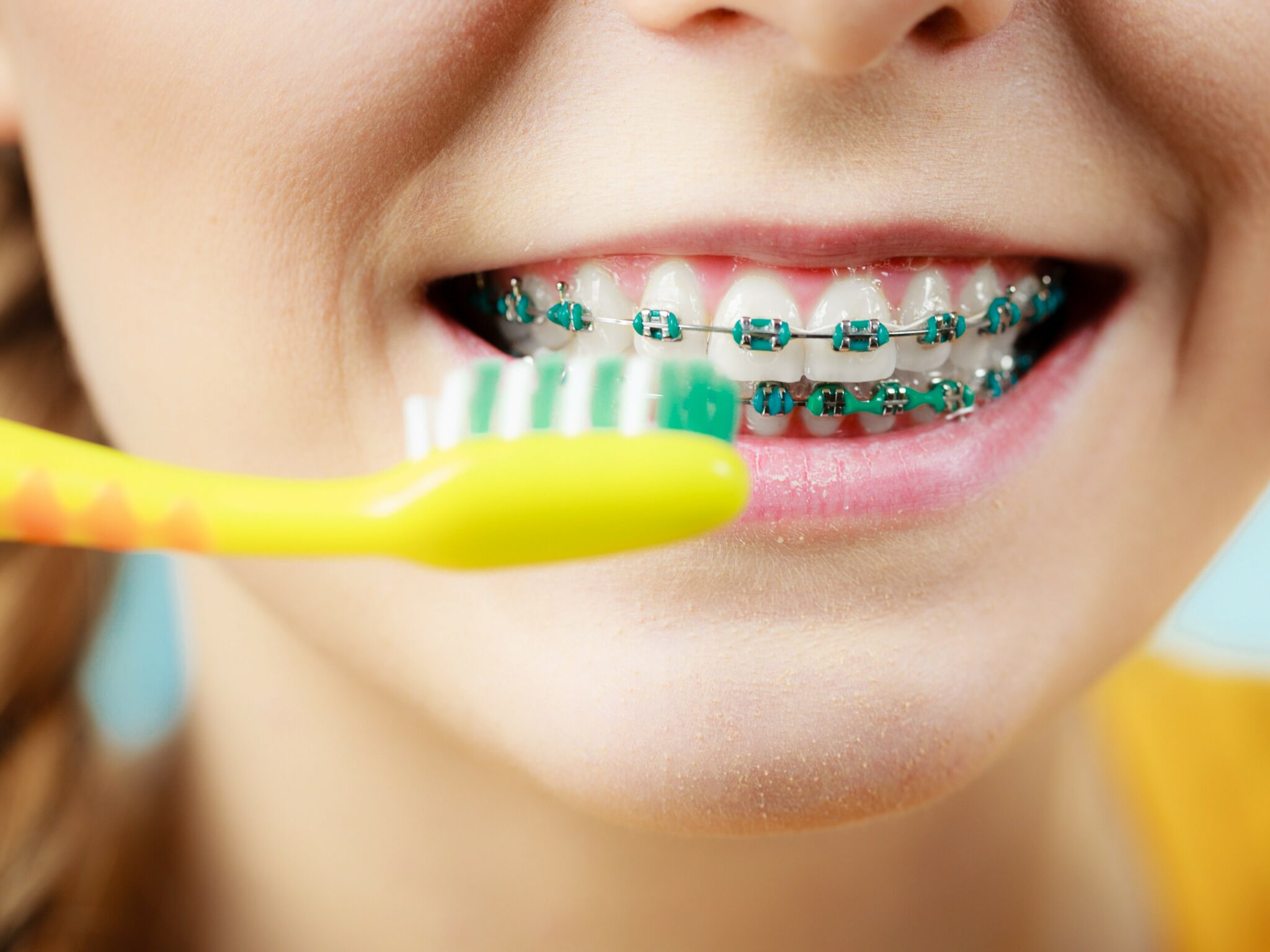 4 Règles à suivre pour la réussite d’un Traitement Orthodontique