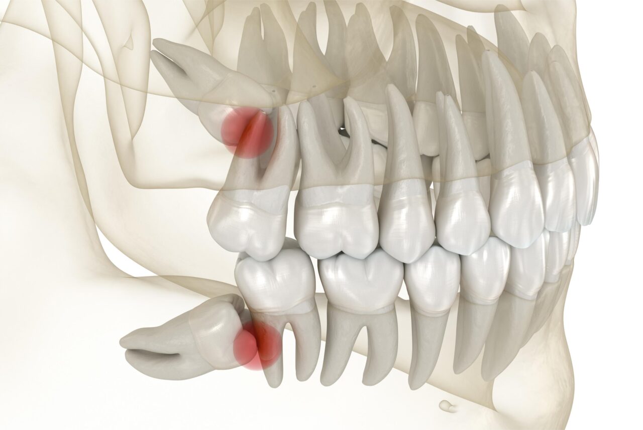 L’extraction des dents de sagesse