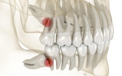 L’extraction des dents de sagesse