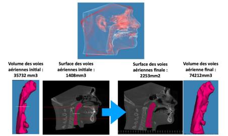 voies aeriennes