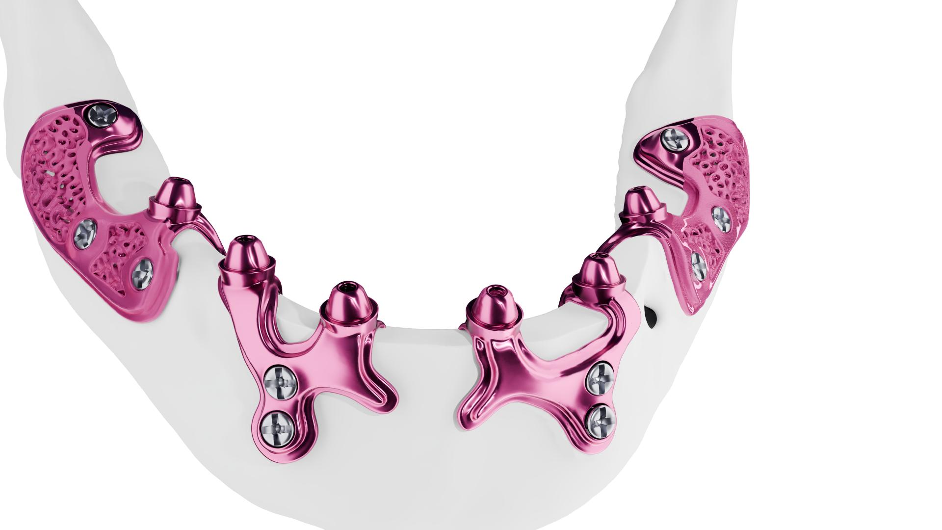 HUG-JOURMAIL-VISUEL-TRANSP-ENTIER.V2 visuel 3D hug implant sous-perioste