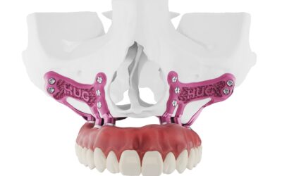 Qu’est-ce qu’un implant sous-périosté ?